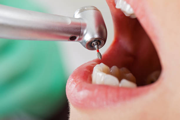 Best Emergency Wisdom Teeth Removal in Platte City, MO